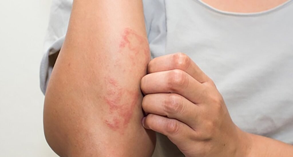 Allergic Reactions
