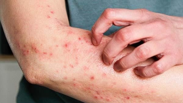 People with Autoimmune Conditions